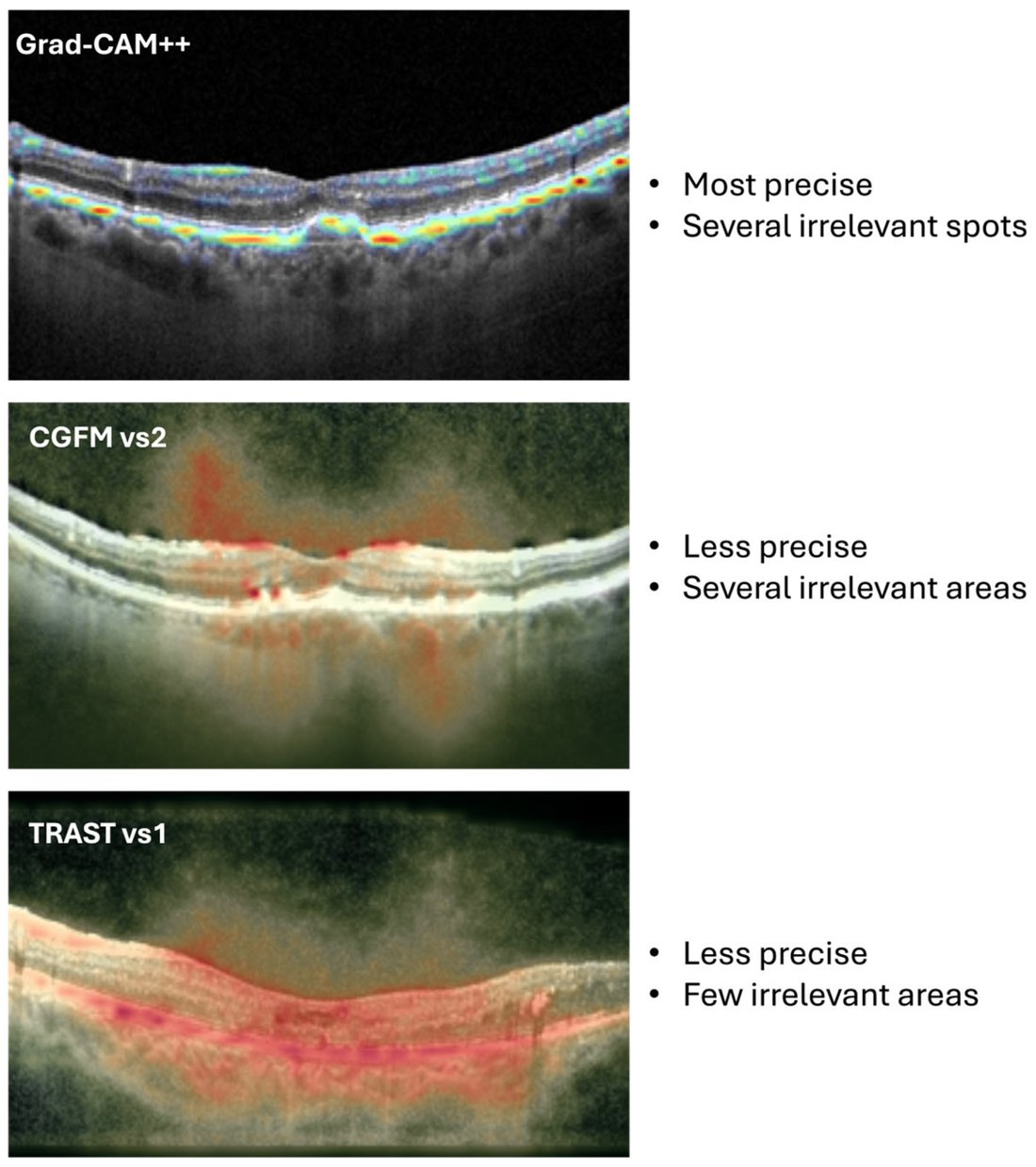Explainable AI heatmaps for OCT retinal disease classification